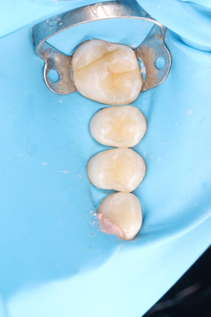 Aesthetic dental restoration with anatomical reconstruction.