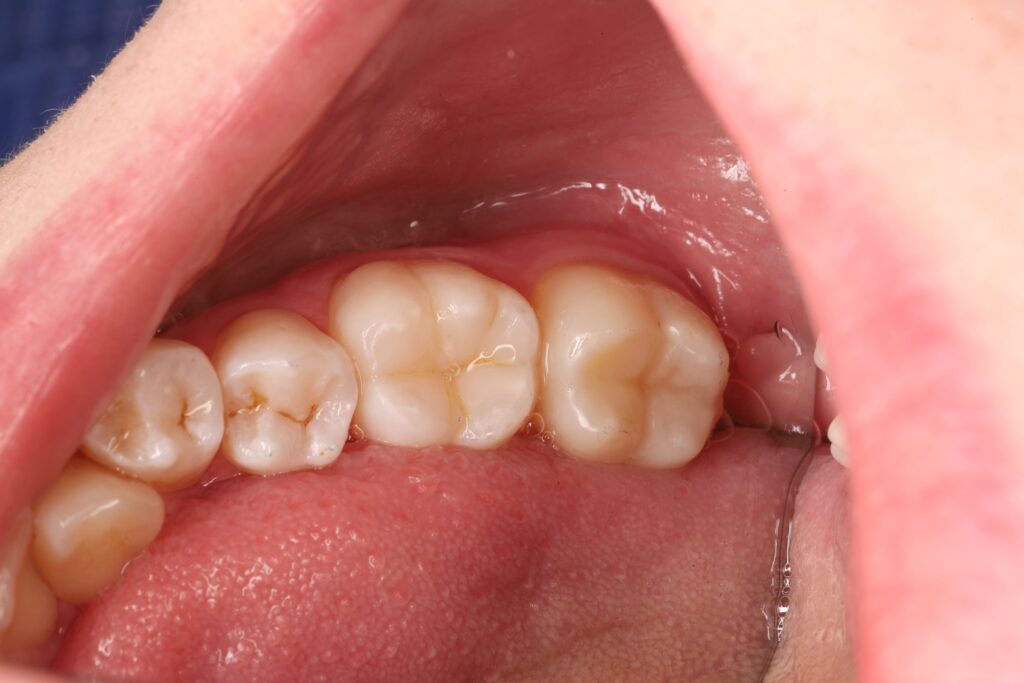 Treatment of a secondary carious lesion.