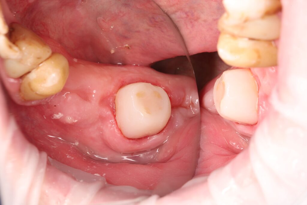 Caries treatment and composite core restoration of the tooth for subsequent prosthetic rehabilitation.