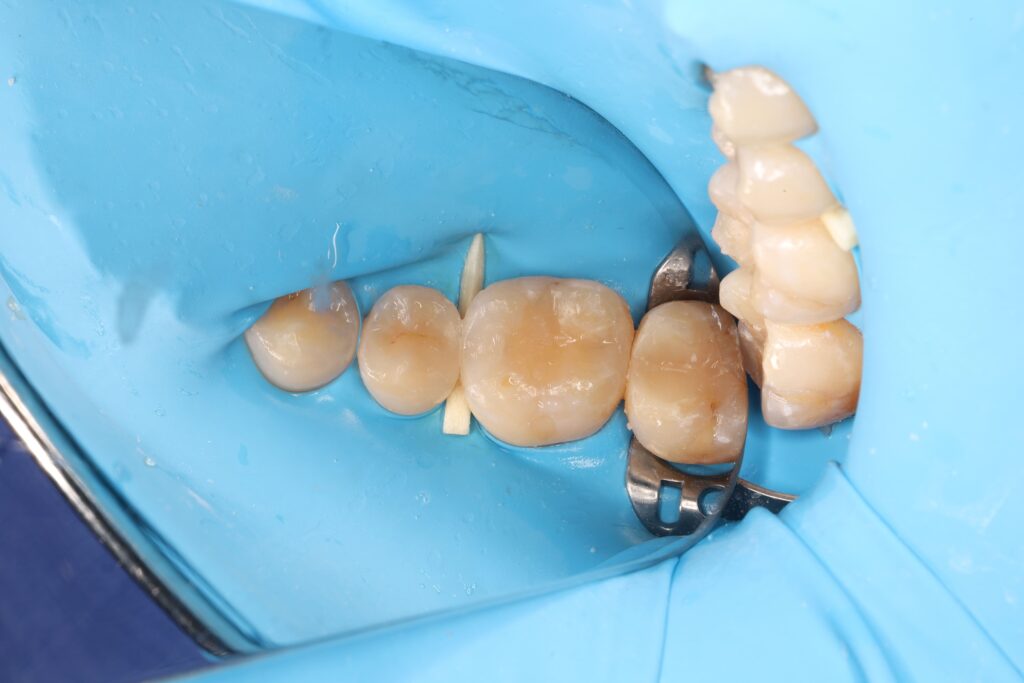Treatment of interproximal caries after completion of orthodontic treatment.
