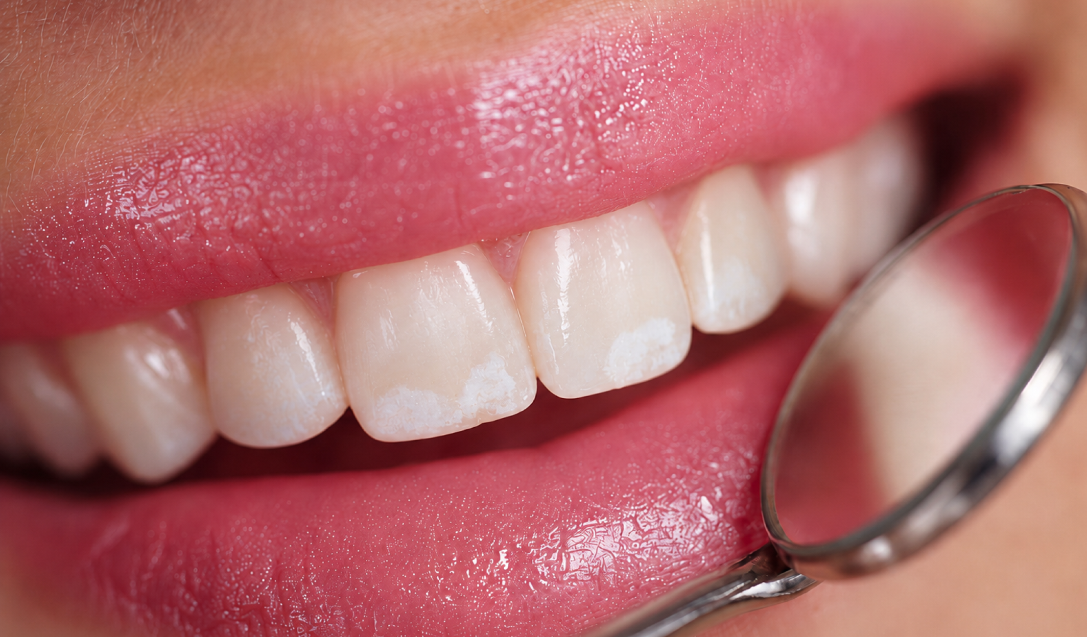 White Spots on Teeth – Causes, Diagnosis, and Effective Treatment