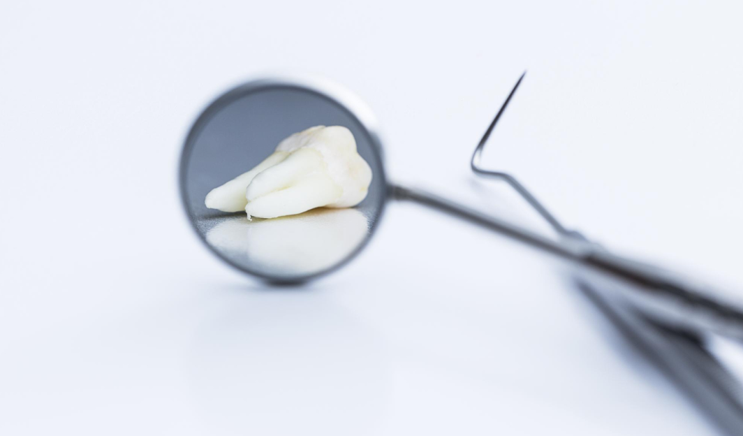 Blood clot after tooth extraction: why it matters and how to avoid complications