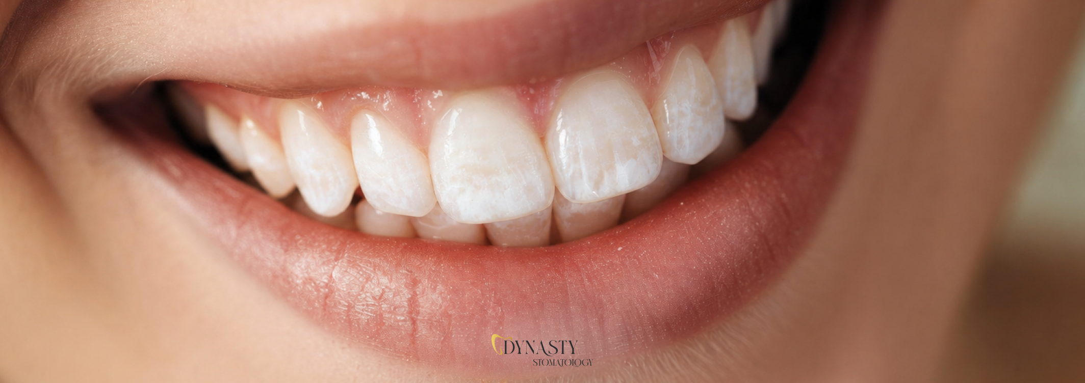 White Spots on Teeth – Causes, Diagnosis, and Effective Treatment